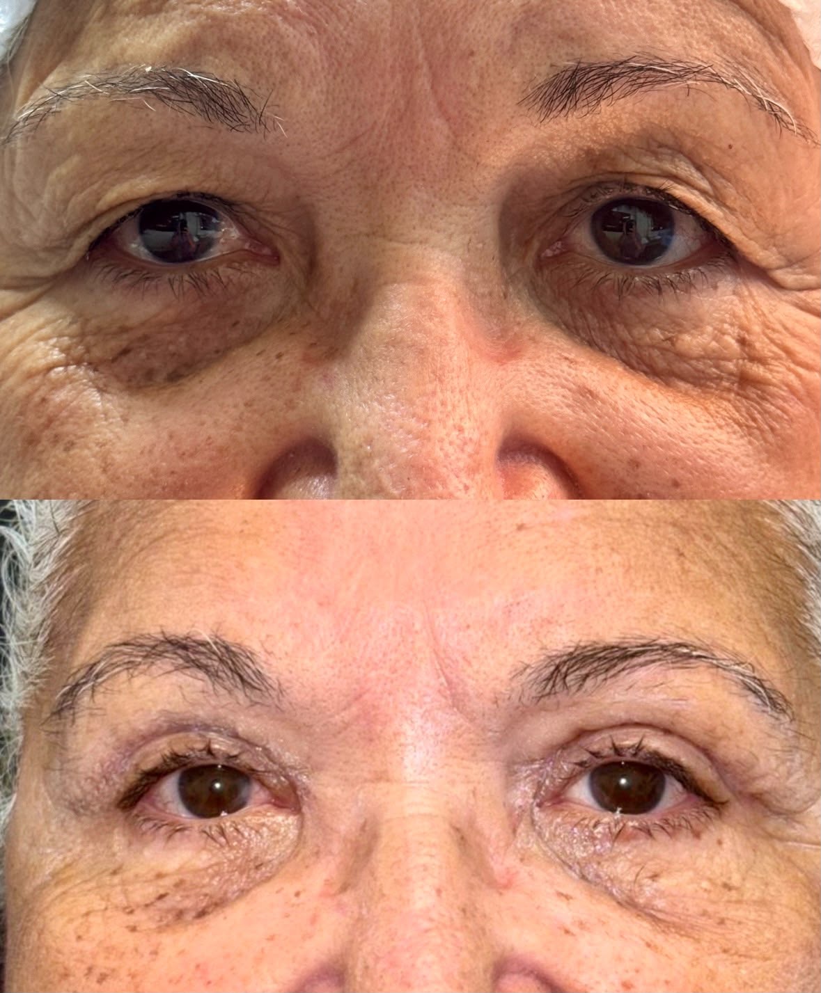Caso de blefaroplastia 4 pálpebras com laser de CO₂, antes e depois