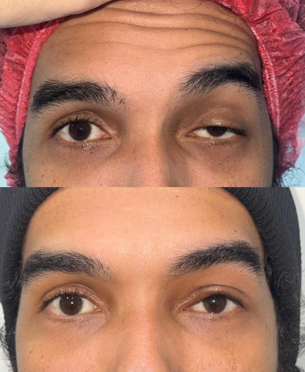 Caso de correção de ptose palpebral, antes e depois