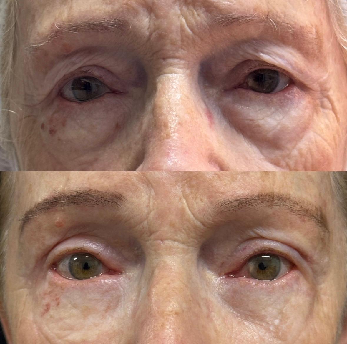 Caso de blefaroplastia, antes e depois
