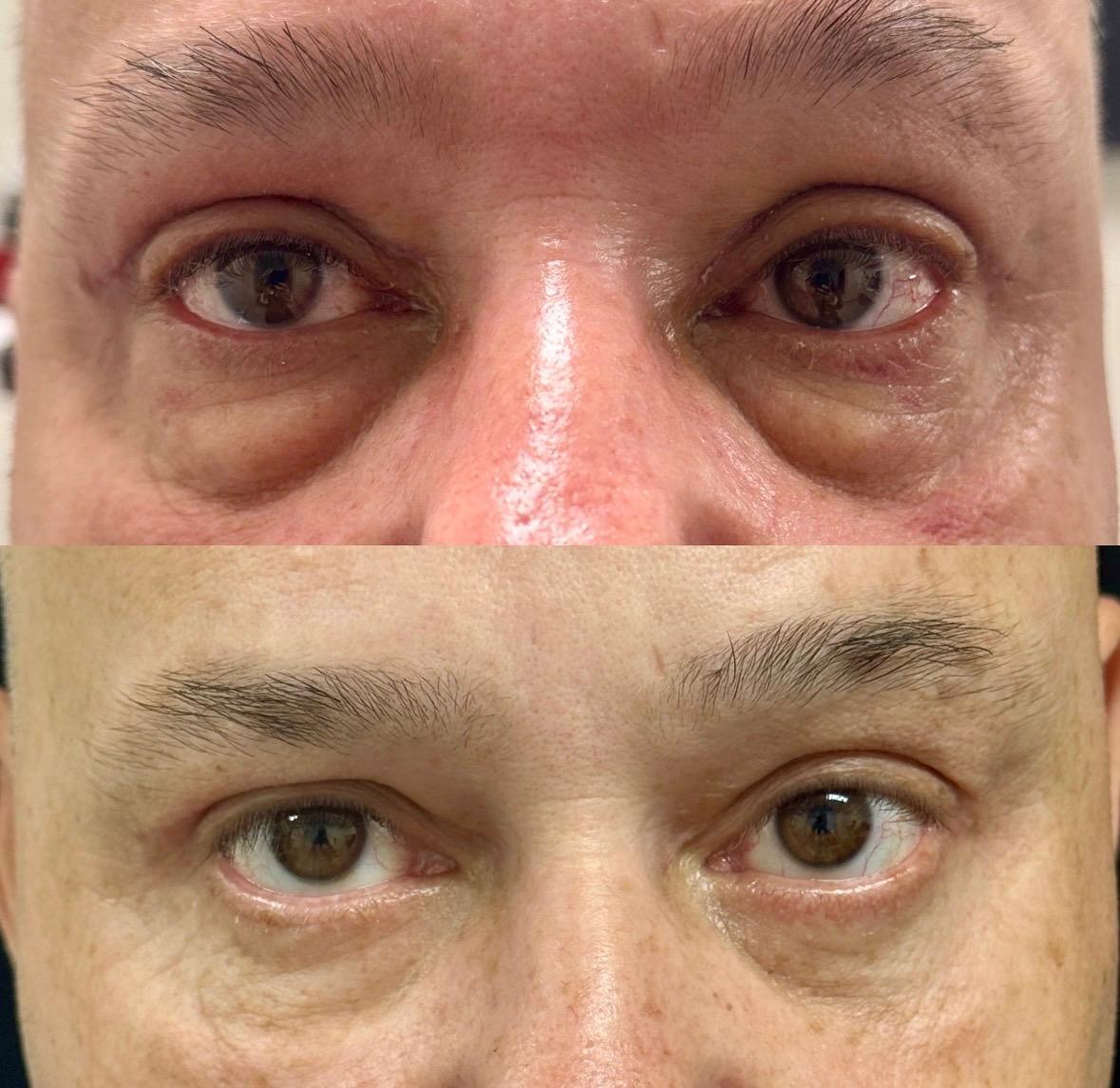 Caso de blefaroplastia inferior, antes e depois